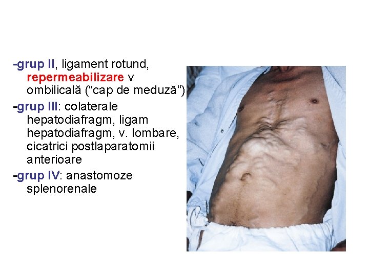 -grup II, ligament rotund, repermeabilizare v ombilicală (“cap de meduză”) -grup III: colaterale hepatodiafragm,