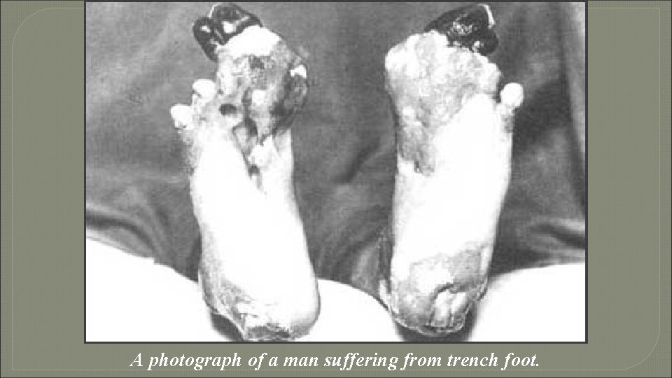 A photograph of a man suffering from trench foot. 