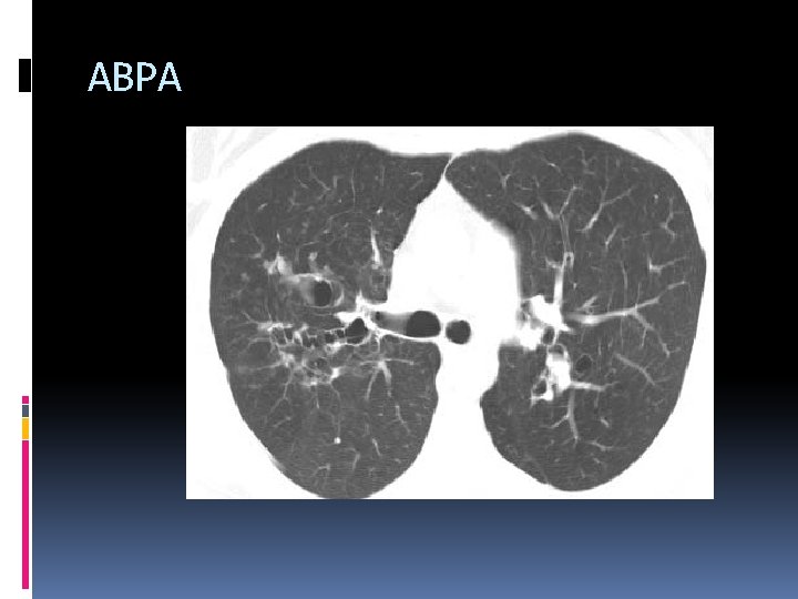 Differential diagnosis of chest diseases Dr Ahmed Refaey