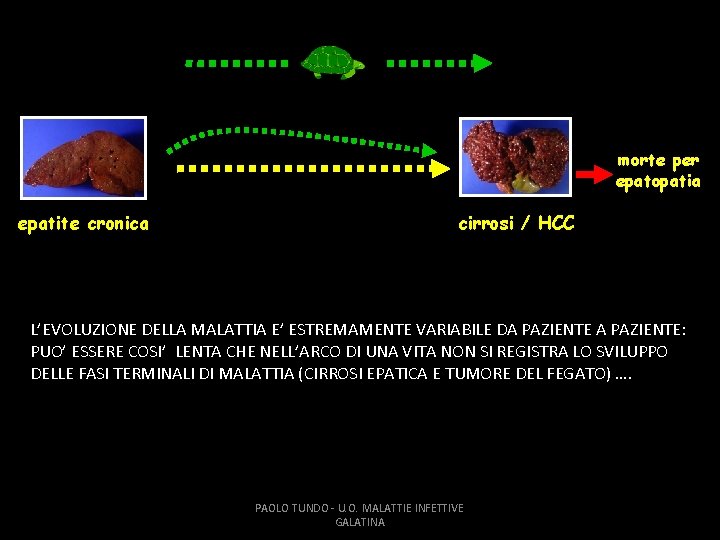 morte per epatopatia epatite cronica cirrosi / HCC L’EVOLUZIONE DELLA MALATTIA E’ ESTREMAMENTE VARIABILE