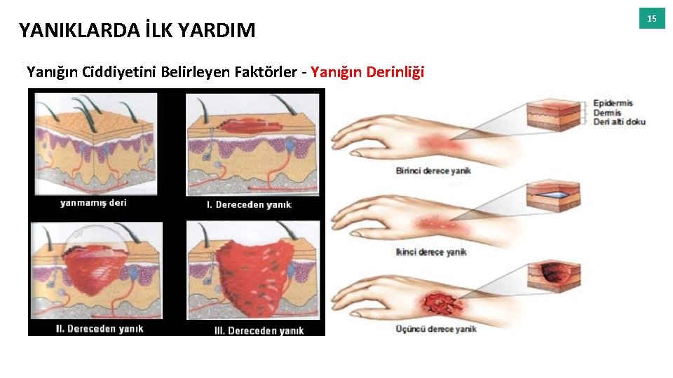 YANIKLARDA İLK YARDIM Yanığın Ciddiyetini Belirleyen Faktörler - Yanığın Derinliği 15 