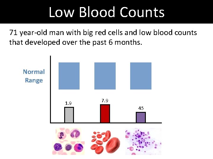 Low Blood Counts 71 year-old man with big red cells and low blood counts Low Blood Counts 71 year-old man with big red cells and low blood counts