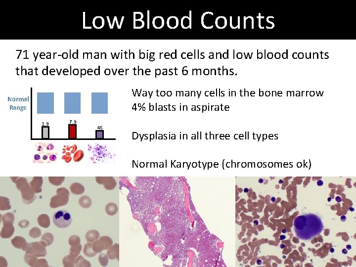 Low Blood Counts 71 year-old man with big red cells and low blood counts Low Blood Counts 71 year-old man with big red cells and low blood counts