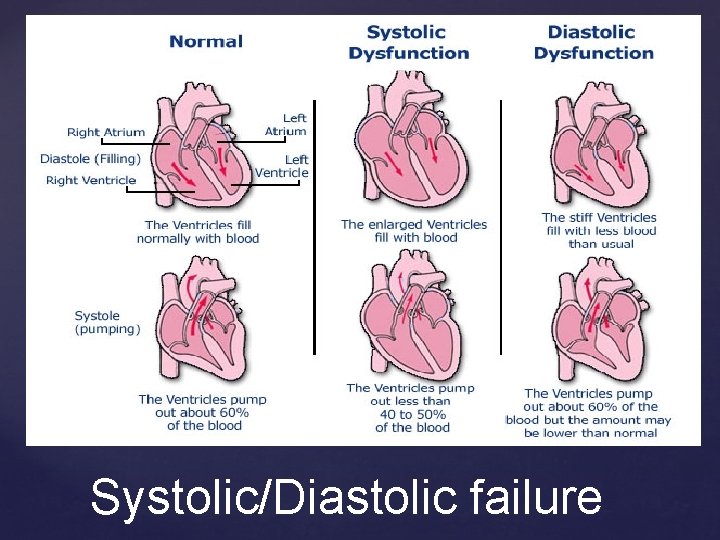 Systolic/Diastolic failure 