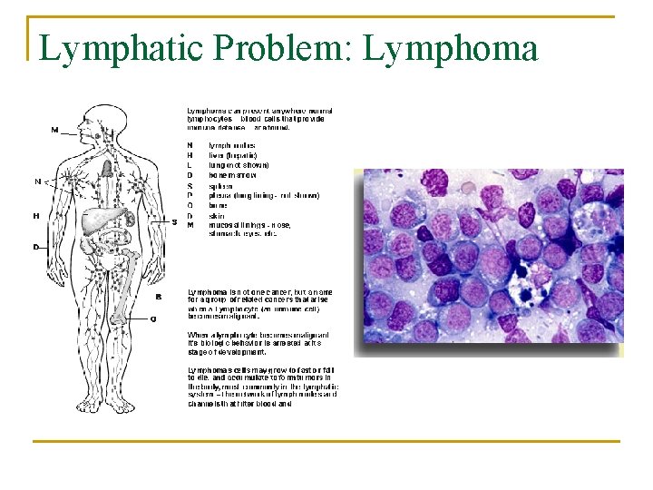 Lymphatic Problem: Lymphoma 