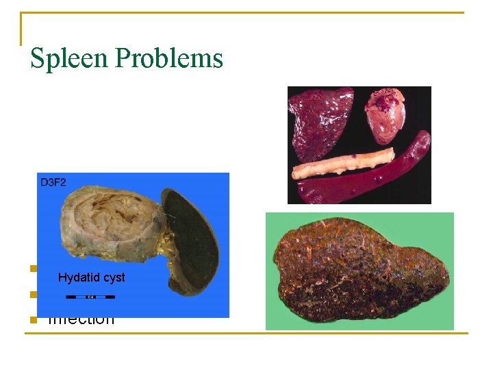 Spleen Problems n n n Rupture Hydatid cyst Cancer Infection 