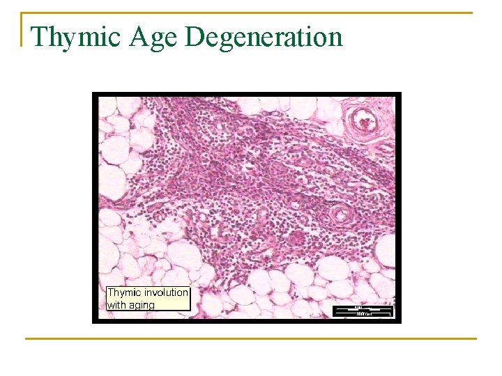 Thymic Age Degeneration 