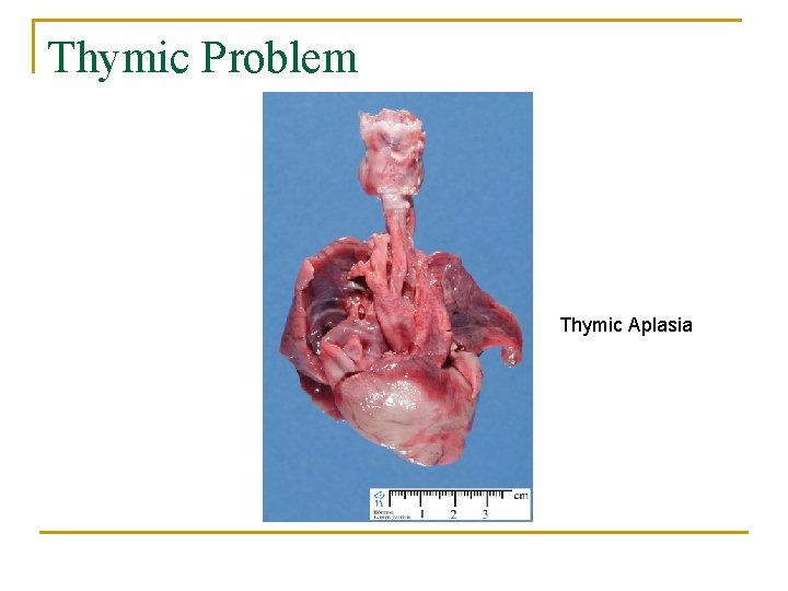 Thymic Problem Thymic Aplasia 