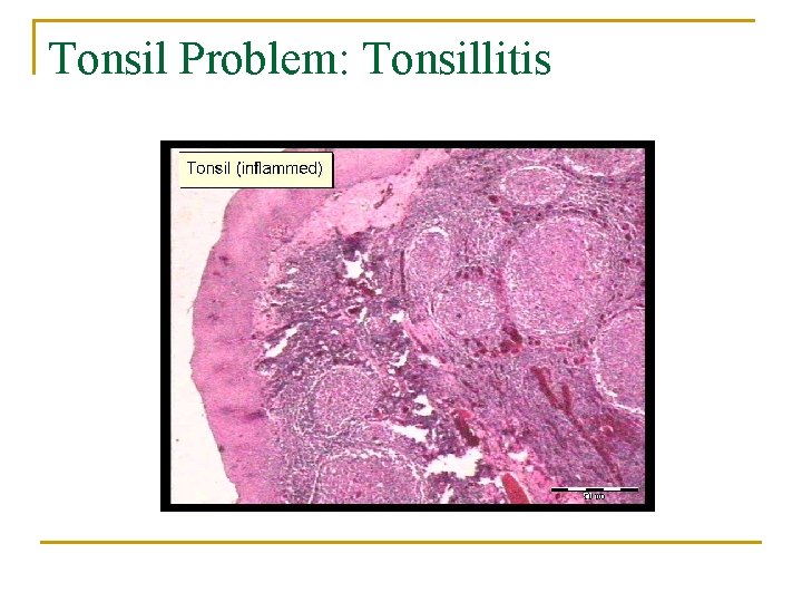 Tonsil Problem: Tonsillitis 