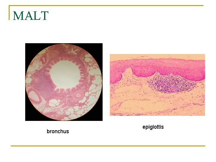 MALT bronchus epiglottis 