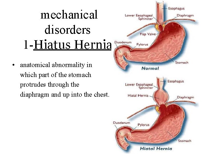 mechanical disorders 1 -Hiatus Hernia • anatomical abnormality in which part of the stomach