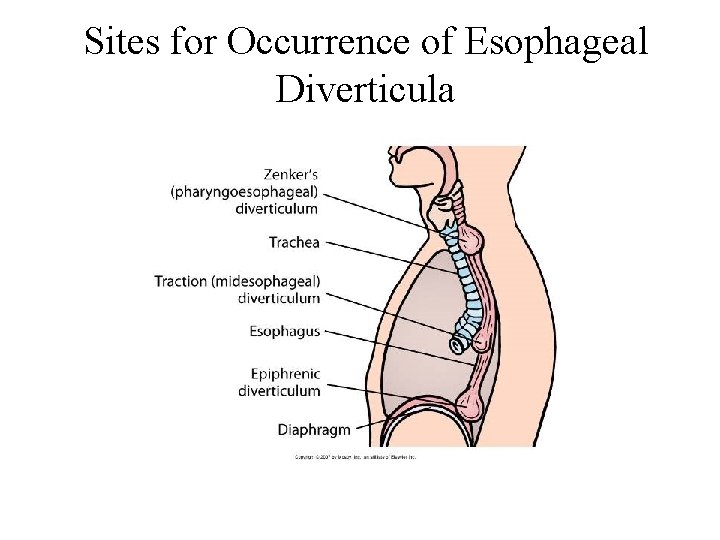 Sites for Occurrence of Esophageal Diverticula 