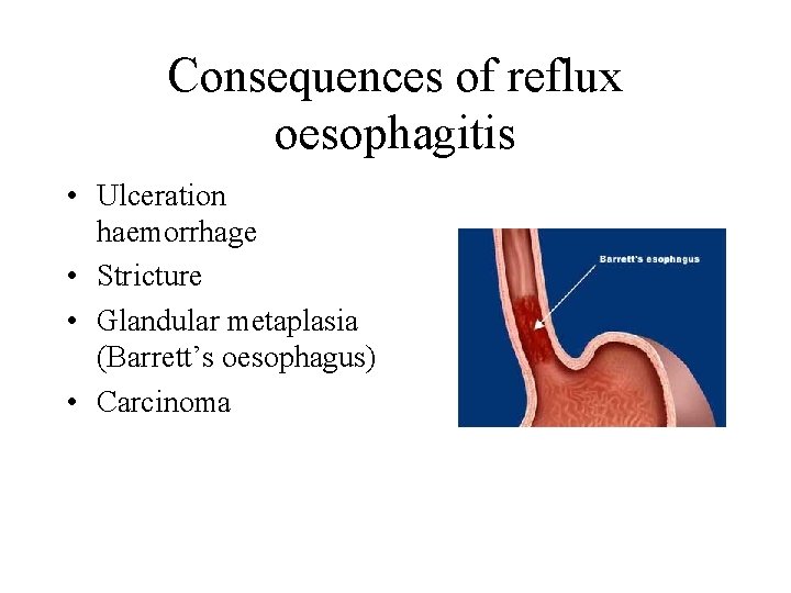 Consequences of reflux oesophagitis • Ulceration haemorrhage • Stricture • Glandular metaplasia (Barrett’s oesophagus)