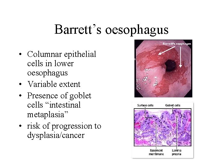 Barrett’s oesophagus • Columnar epithelial cells in lower oesophagus • Variable extent • Presence
