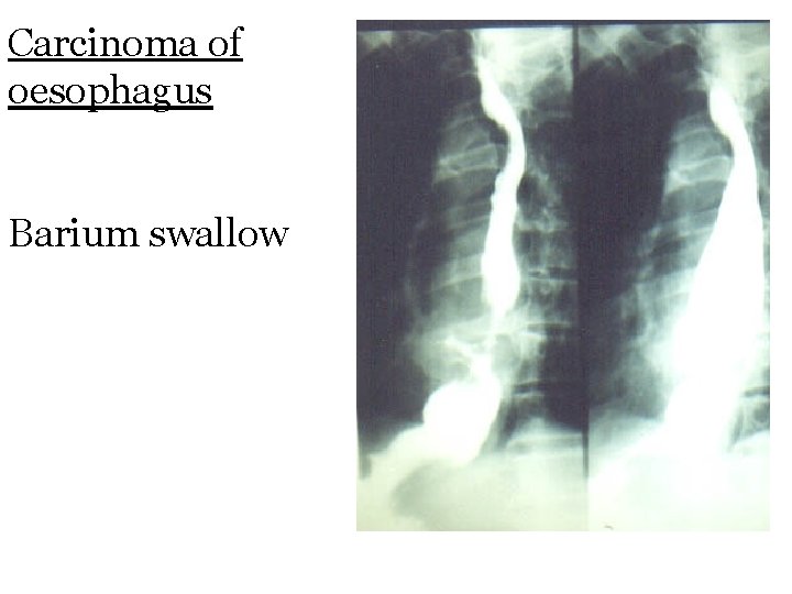 Carcinoma of oesophagus Barium swallow 