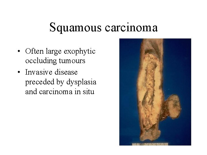 Squamous carcinoma • Often large exophytic occluding tumours • Invasive disease preceded by dysplasia