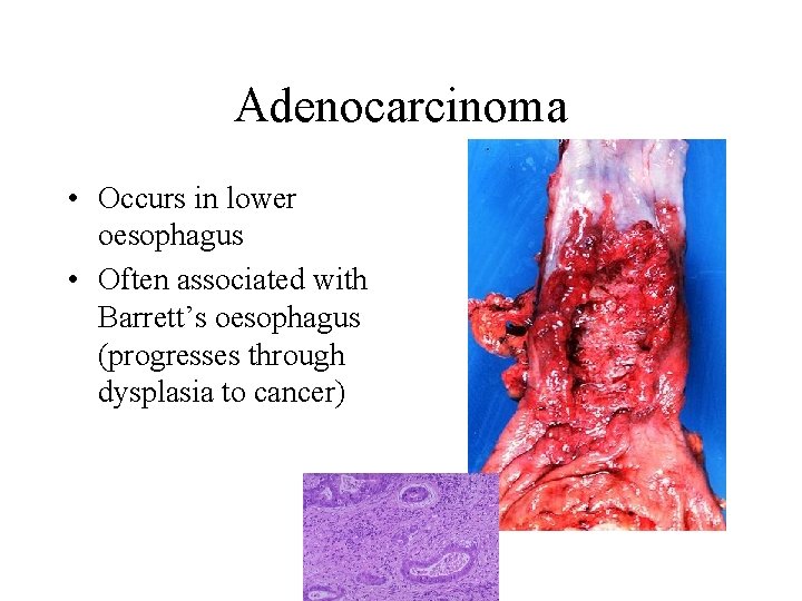 Adenocarcinoma • Occurs in lower oesophagus • Often associated with Barrett’s oesophagus (progresses through