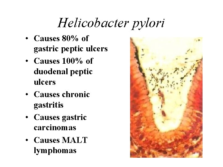 Helicobacter pylori • Causes 80% of gastric peptic ulcers • Causes 100% of duodenal