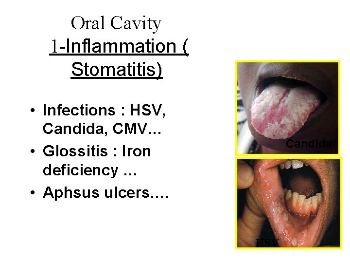 Oral Cavity 1 -Inflammation ( Stomatitis) • Infections : HSV, Candida, CMV… • Glossitis