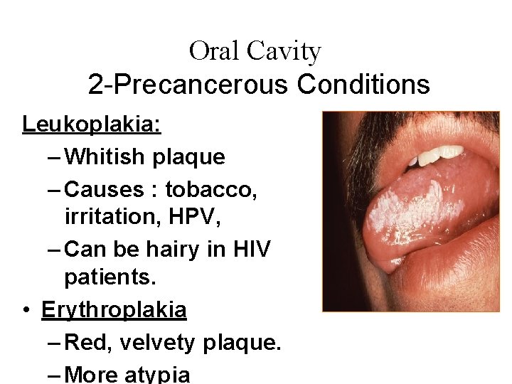 Oral Cavity 2 -Precancerous Conditions Leukoplakia: – Whitish plaque – Causes : tobacco, irritation,