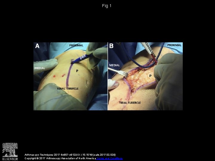 Fig 1 Arthroscopy Techniques 2017 6 e 907 -e 912 DOI: (10. 1016/j. eats.