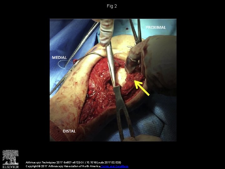 Fig 2 Arthroscopy Techniques 2017 6 e 907 -e 912 DOI: (10. 1016/j. eats.