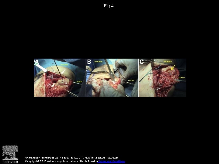 Fig 4 Arthroscopy Techniques 2017 6 e 907 -e 912 DOI: (10. 1016/j. eats.