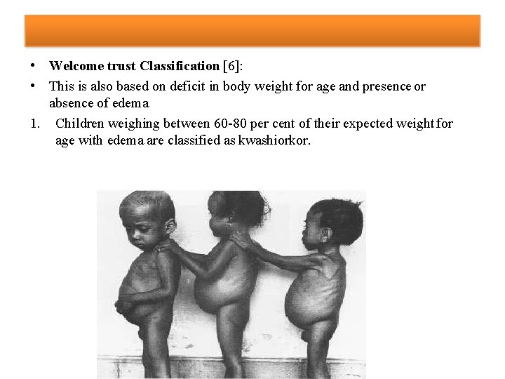  • Welcome trust Classification [6]: • This is also based on deficit in