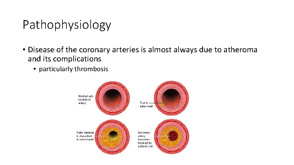 Pathophysiology • Disease of the coronary arteries is almost always due to atheroma and