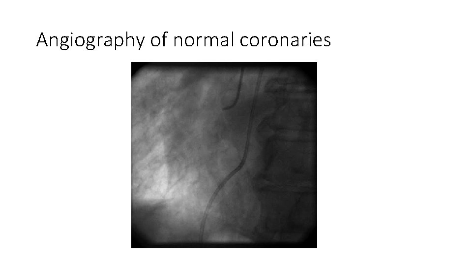 Angiography of normal coronaries 