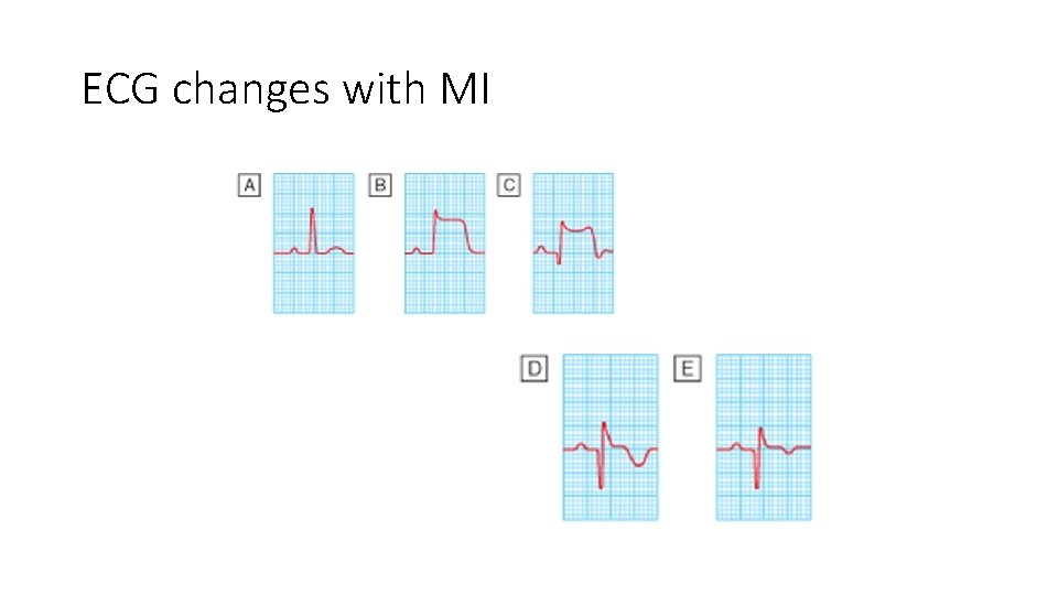 ECG changes with MI 