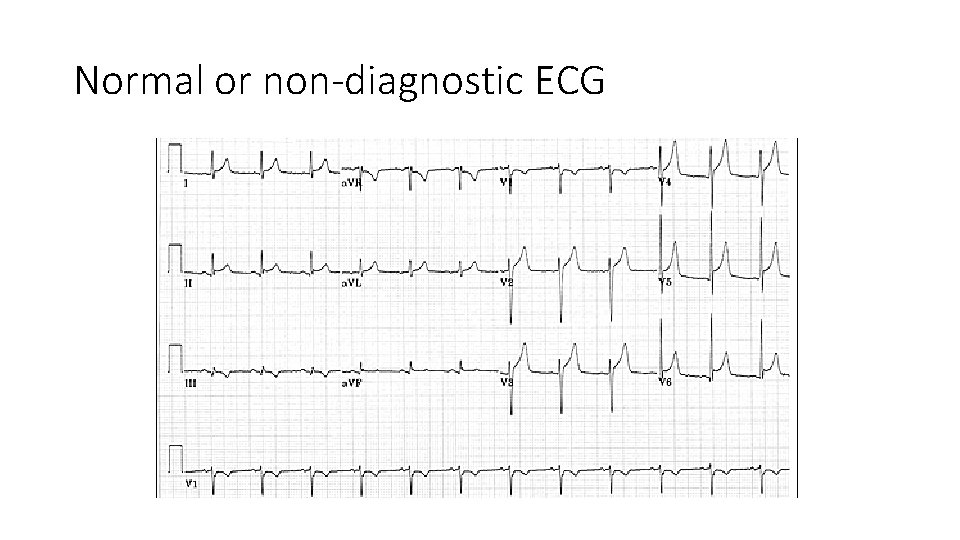 Normal or non-diagnostic ECG 