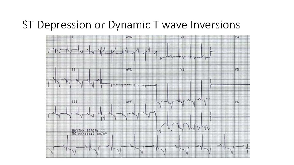 ST Depression or Dynamic T wave Inversions 