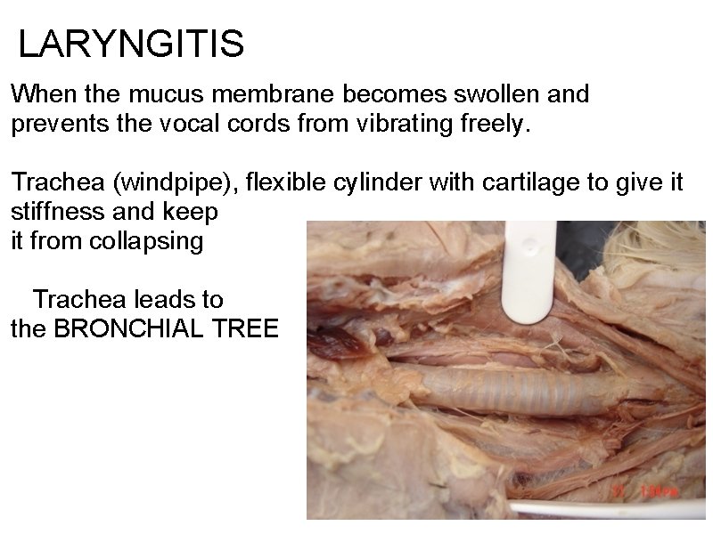 LARYNGITIS When the mucus membrane becomes swollen and prevents the vocal cords from vibrating LARYNGITIS When the mucus membrane becomes swollen and prevents the vocal cords from vibrating