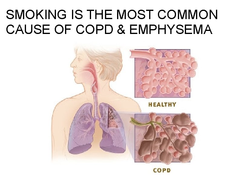 SMOKING IS THE MOST COMMON CAUSE OF COPD & EMPHYSEMA SMOKING IS THE MOST COMMON CAUSE OF COPD & EMPHYSEMA