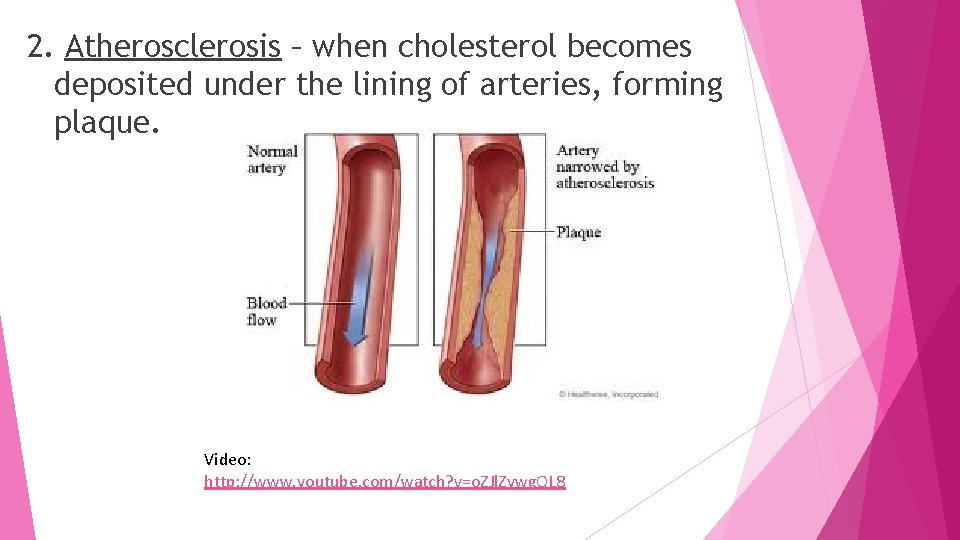 2. Atherosclerosis – when cholesterol becomes deposited under the lining of arteries, forming plaque.