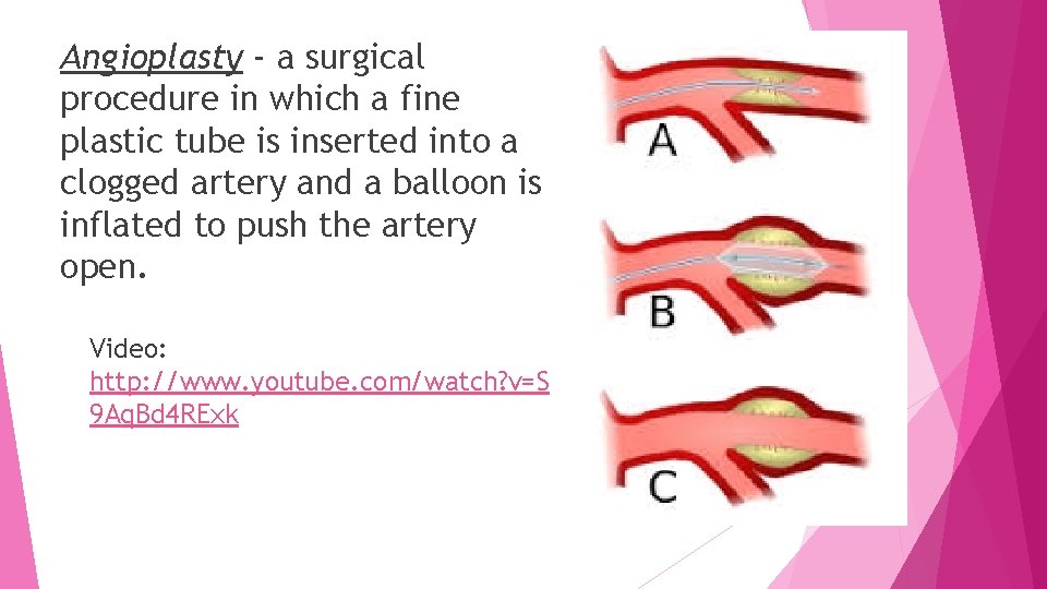 Angioplasty - a surgical procedure in which a fine plastic tube is inserted into
