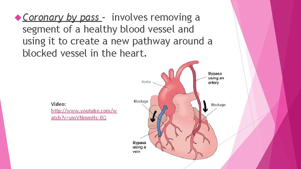  Coronary by pass - involves removing a segment of a healthy blood vessel