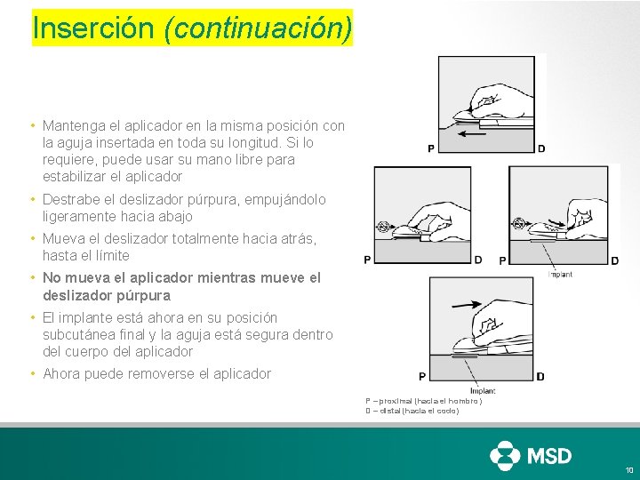 Inserción (continuación) • Mantenga el aplicador en la misma posición con la aguja insertada Inserción (continuación) • Mantenga el aplicador en la misma posición con la aguja insertada