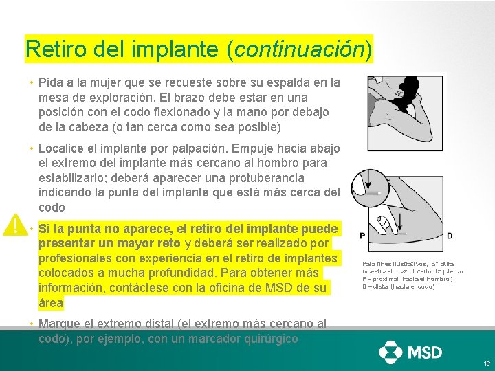 Retiro del implante (continuación) • Pida a la mujer que se recueste sobre su Retiro del implante (continuación) • Pida a la mujer que se recueste sobre su