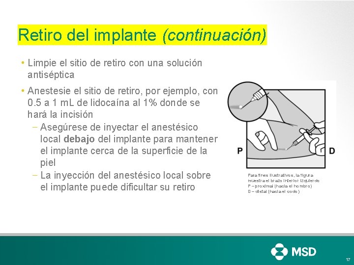 Retiro del implante (continuación) • Limpie el sitio de retiro con una solución antiséptica Retiro del implante (continuación) • Limpie el sitio de retiro con una solución antiséptica