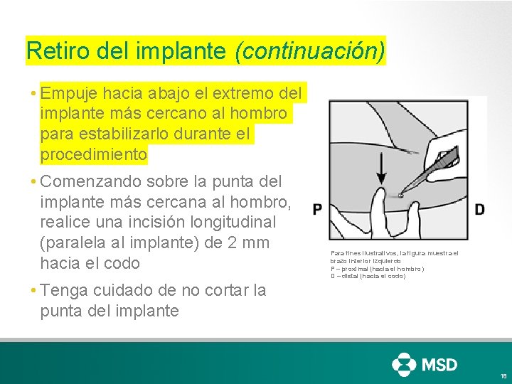 Retiro del implante (continuación) • Empuje hacia abajo el extremo del implante más cercano Retiro del implante (continuación) • Empuje hacia abajo el extremo del implante más cercano