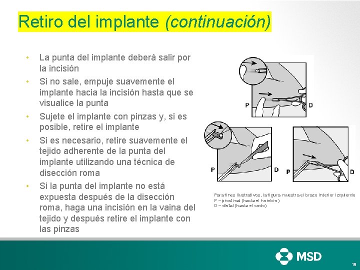 Retiro del implante (continuación) • • • La punta del implante deberá salir por Retiro del implante (continuación) • • • La punta del implante deberá salir por