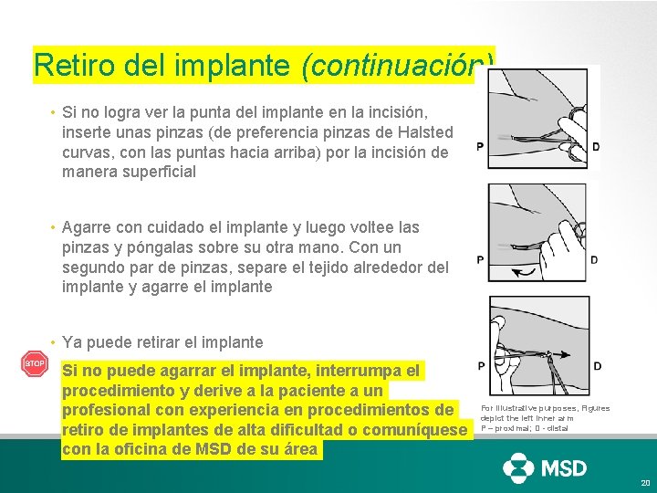 Retiro del implante (continuación) • Si no logra ver la punta del implante en Retiro del implante (continuación) • Si no logra ver la punta del implante en