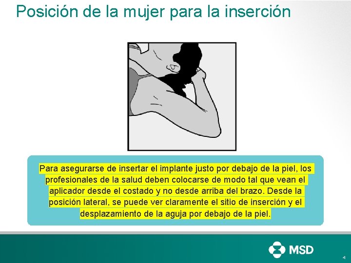 Posición de la mujer para la inserción Para asegurarse de insertar el implante justo Posición de la mujer para la inserción Para asegurarse de insertar el implante justo
