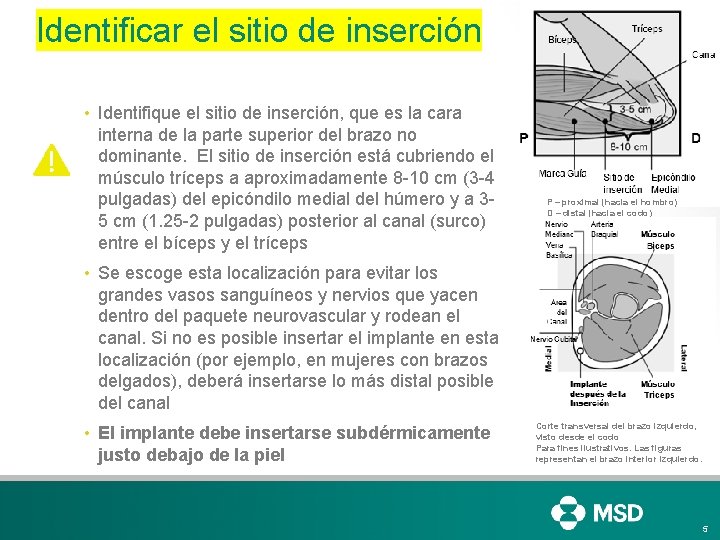 Identificar el sitio de inserción • Identifique el sitio de inserción, que es la Identificar el sitio de inserción • Identifique el sitio de inserción, que es la