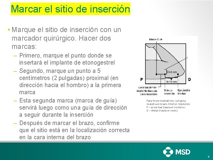 Marcar el sitio de inserción • Marque el sitio de inserción con un marcador Marcar el sitio de inserción • Marque el sitio de inserción con un marcador