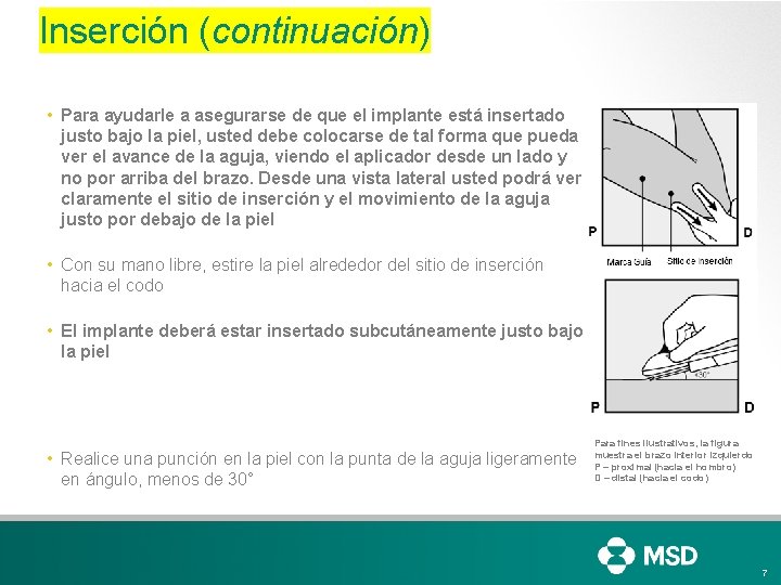 Inserción (continuación) • Para ayudarle a asegurarse de que el implante está insertado justo Inserción (continuación) • Para ayudarle a asegurarse de que el implante está insertado justo