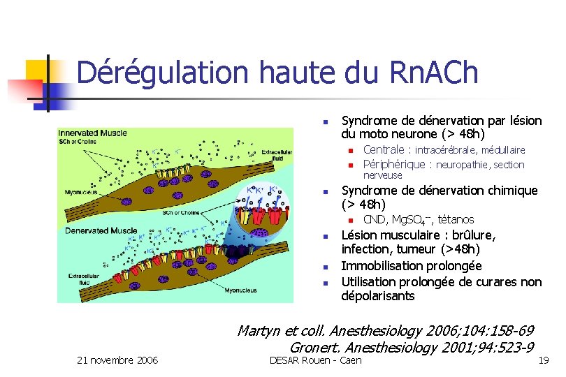 Dérégulation haute du Rn. ACh n Syndrome de dénervation par lésion du moto neurone