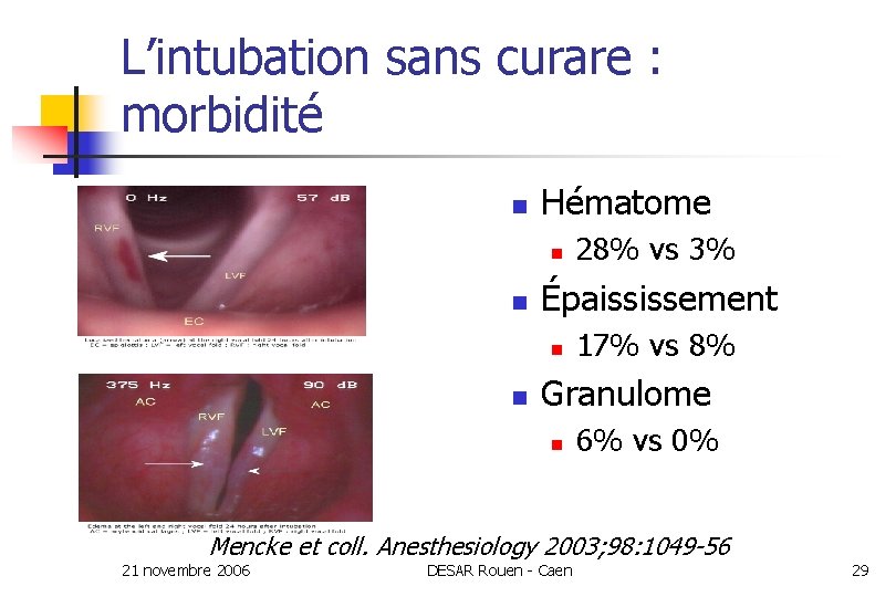 L’intubation sans curare : morbidité n Hématome n n Épaississement n n 28% vs